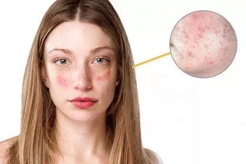 春季過敏不止你一個 預防要專業！